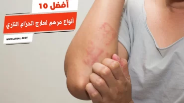 أفضل 10 أنواع مرهم لعلاج الحزام الناري