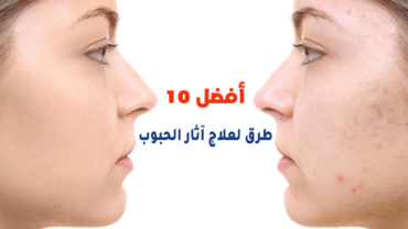 أفضل 10 طرق لعلاج آثار الحبوب