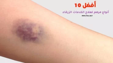 أفضل 10 أنواع مرهم لعلاج الكدمات الزرقاء